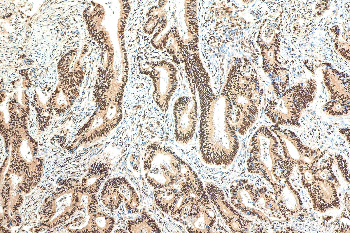 Immunohistochemistry (IHC) staining of human colon cancer tissue using FIP1L1 Polyclonal antibody (12276-1-AP)