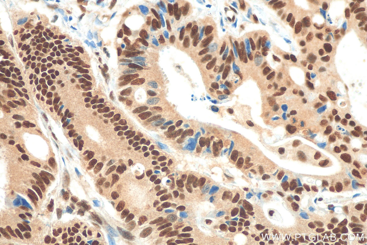 Immunohistochemistry (IHC) staining of human colon cancer tissue using FIP1L1 Polyclonal antibody (12276-1-AP)