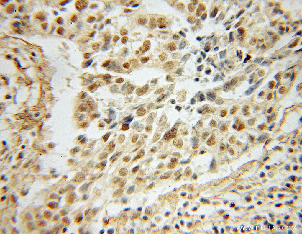 Immunohistochemistry (IHC) staining of human ovary tumor tissue using FIP1L1 Polyclonal antibody (12276-1-AP)