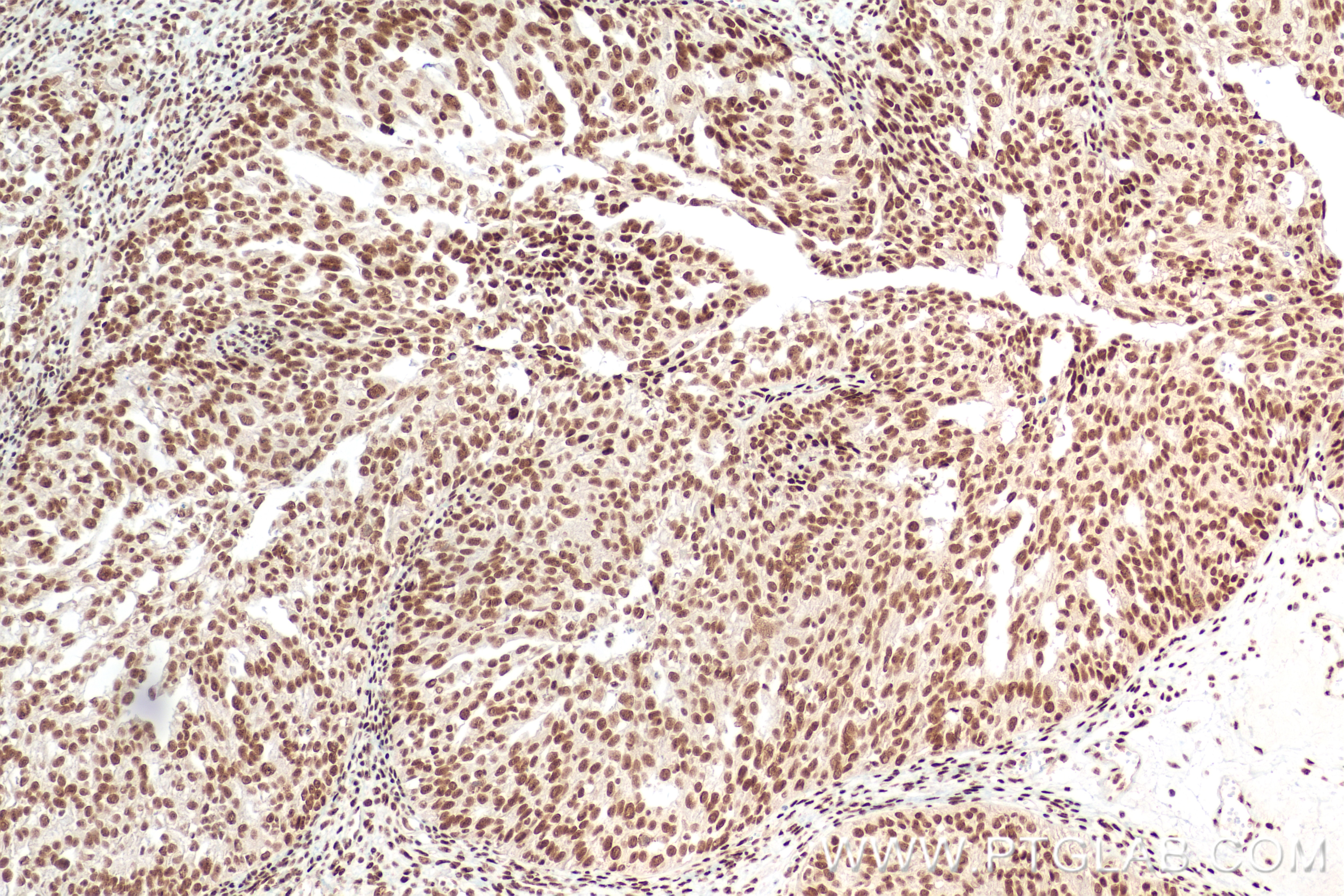 Immunohistochemistry (IHC) staining of human ovary cancer tissue using FIP1L1 Recombinant antibody (83863-3-RR)