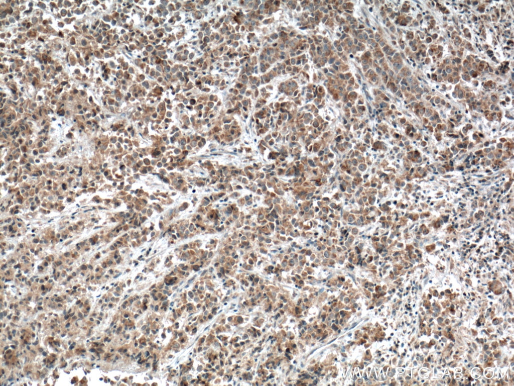 Immunohistochemistry (IHC) staining of human prostate cancer tissue using FIS1 Monoclonal antibody (66635-1-Ig)