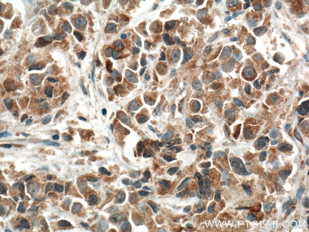 IHC staining of human prostate cancer using 66635-1-Ig