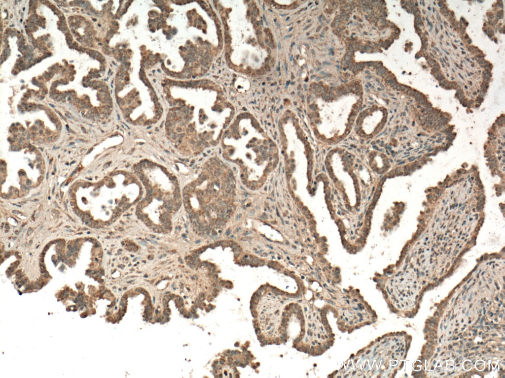 Immunohistochemistry (IHC) staining of human ovary tumor tissue using FIS1 Monoclonal antibody (66635-1-Ig)