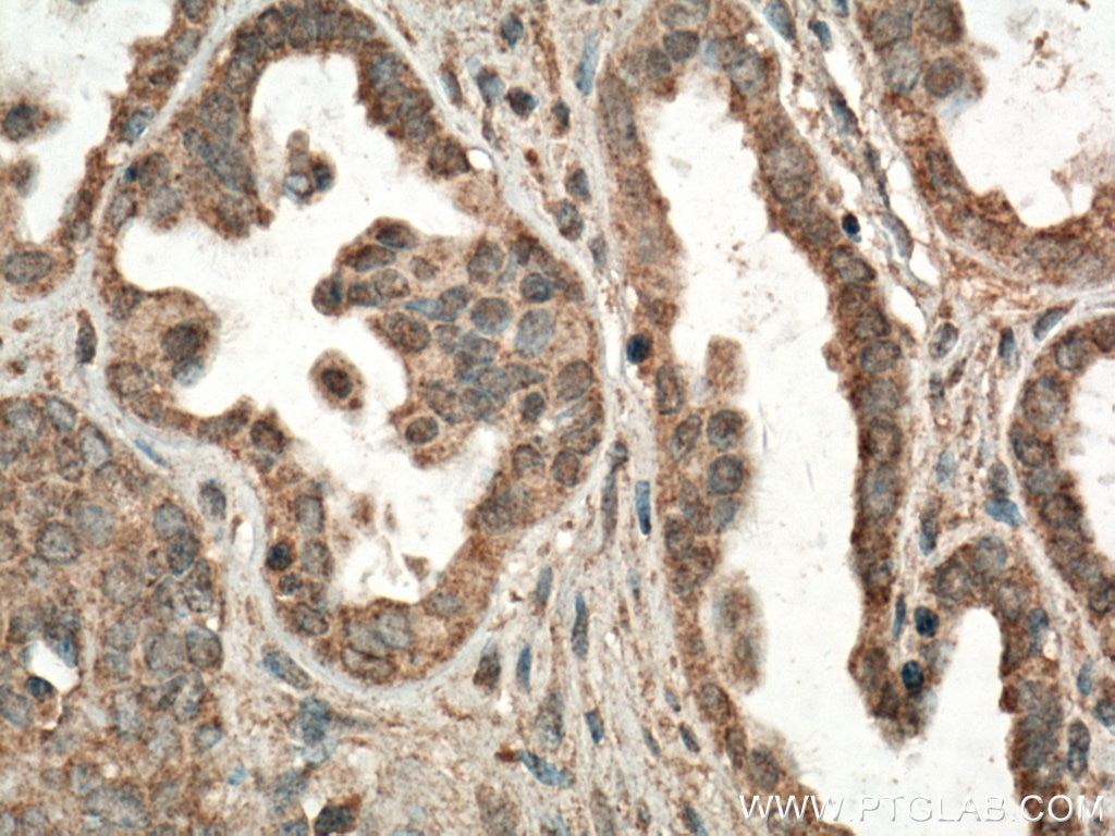 Immunohistochemistry (IHC) staining of human ovary tumor tissue using FIS1 Monoclonal antibody (66635-1-Ig)