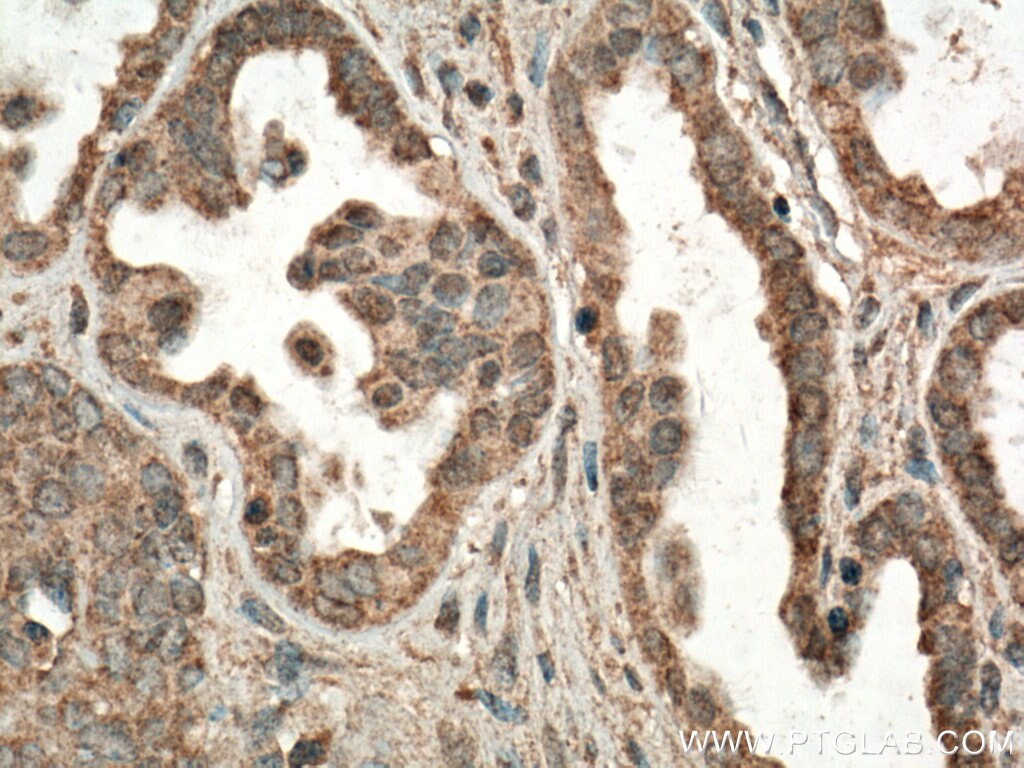 IHC staining of human ovary tumor using 66635-1-Ig