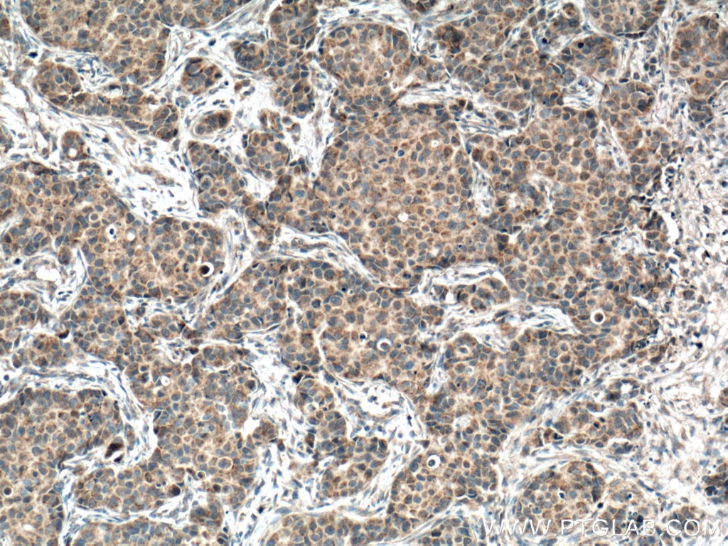 Immunohistochemistry (IHC) staining of human breast cancer tissue using FIS1 Monoclonal antibody (66635-1-Ig)