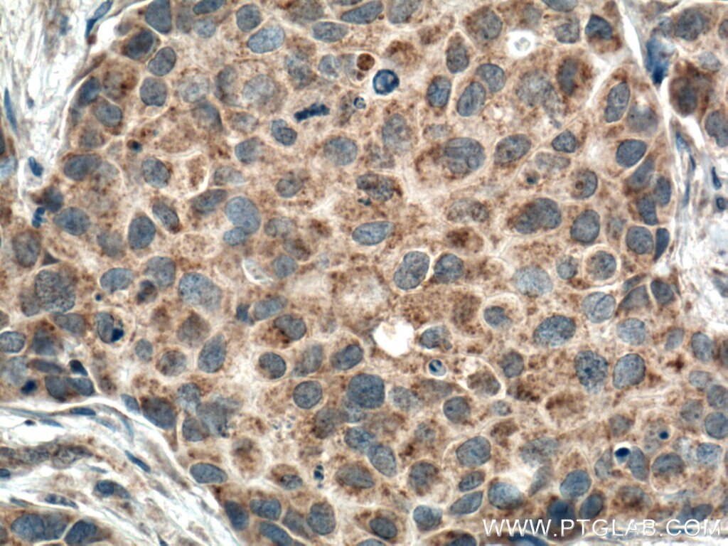 Immunohistochemistry (IHC) staining of human breast cancer tissue using FIS1 Monoclonal antibody (66635-1-Ig)