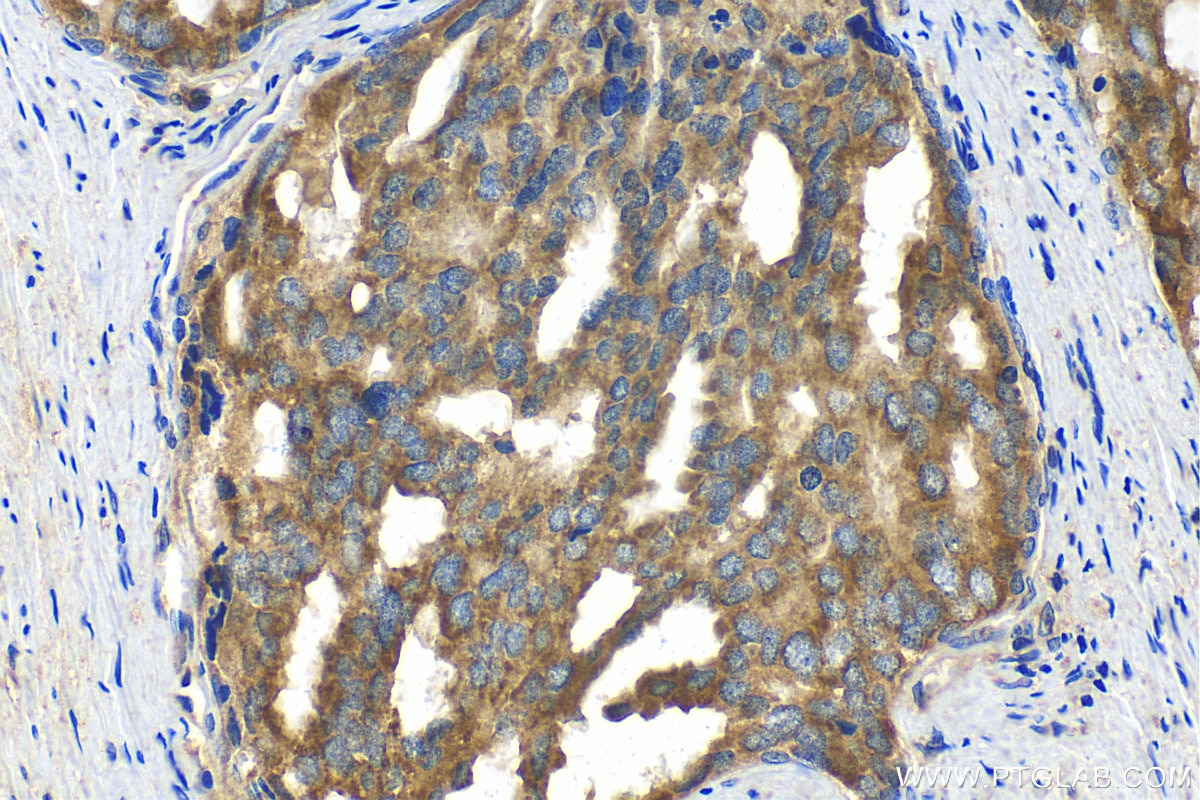 Immunohistochemistry (IHC) staining of human prostate cancer tissue using FIS1 Recombinant antibody (82248-1-RR)