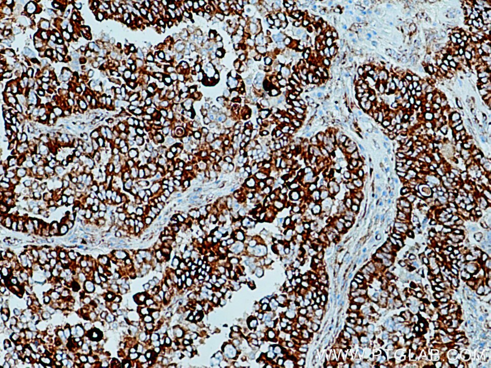 Immunohistochemistry (IHC) staining of human ovary tumor tissue using FKBP10/FKBP65 Polyclonal antibody (12172-1-AP)