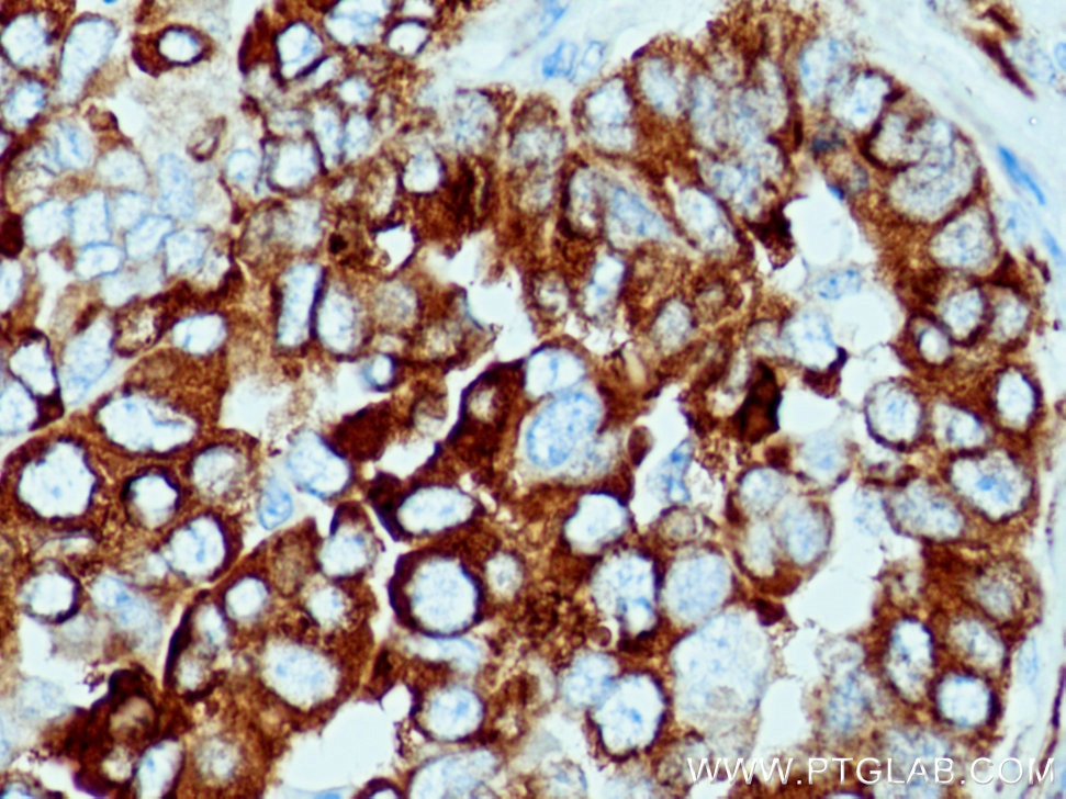 Immunohistochemistry (IHC) staining of human ovary tumor tissue using FKBP10/FKBP65 Polyclonal antibody (12172-1-AP)