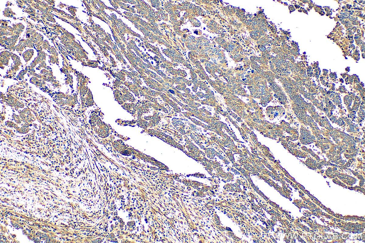 Immunohistochemistry (IHC) staining of human ovary tumor tissue using FKBP10/FKBP65 Recombinant antibody (81567-1-RR)