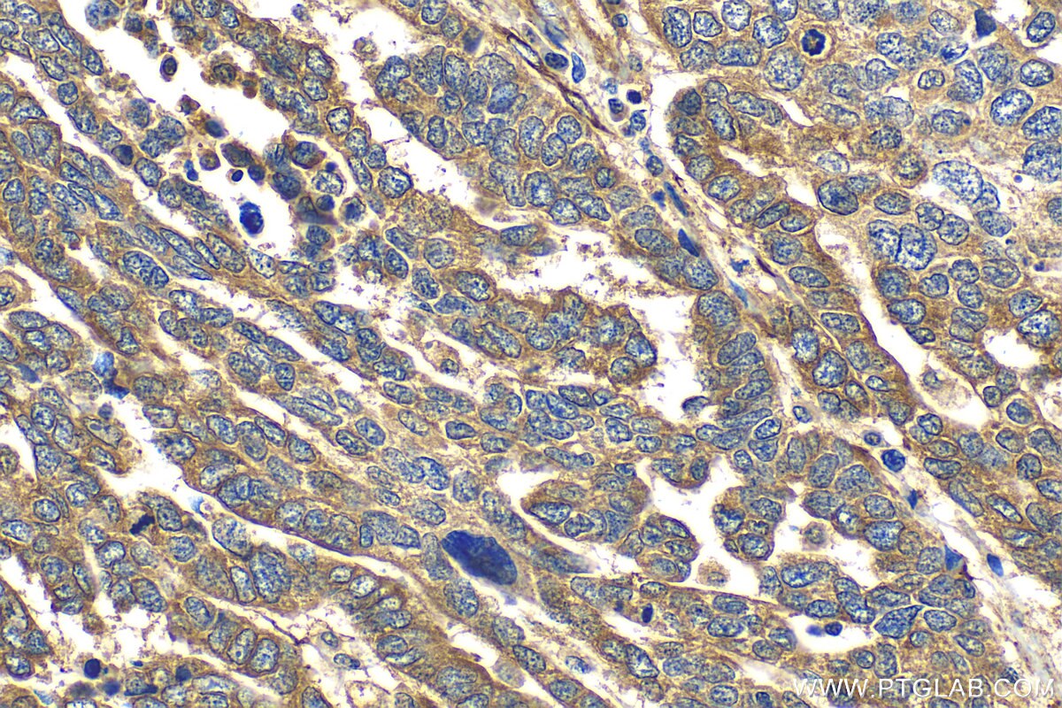 Immunohistochemistry (IHC) staining of human ovary tumor tissue using FKBP10/FKBP65 Recombinant antibody (81567-1-RR)