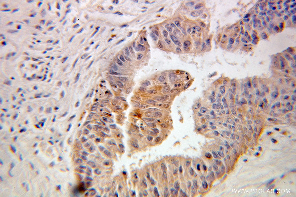 Immunohistochemistry (IHC) staining of human ovary tumor tissue using FKBP1A Polyclonal antibody (10273-1-AP)