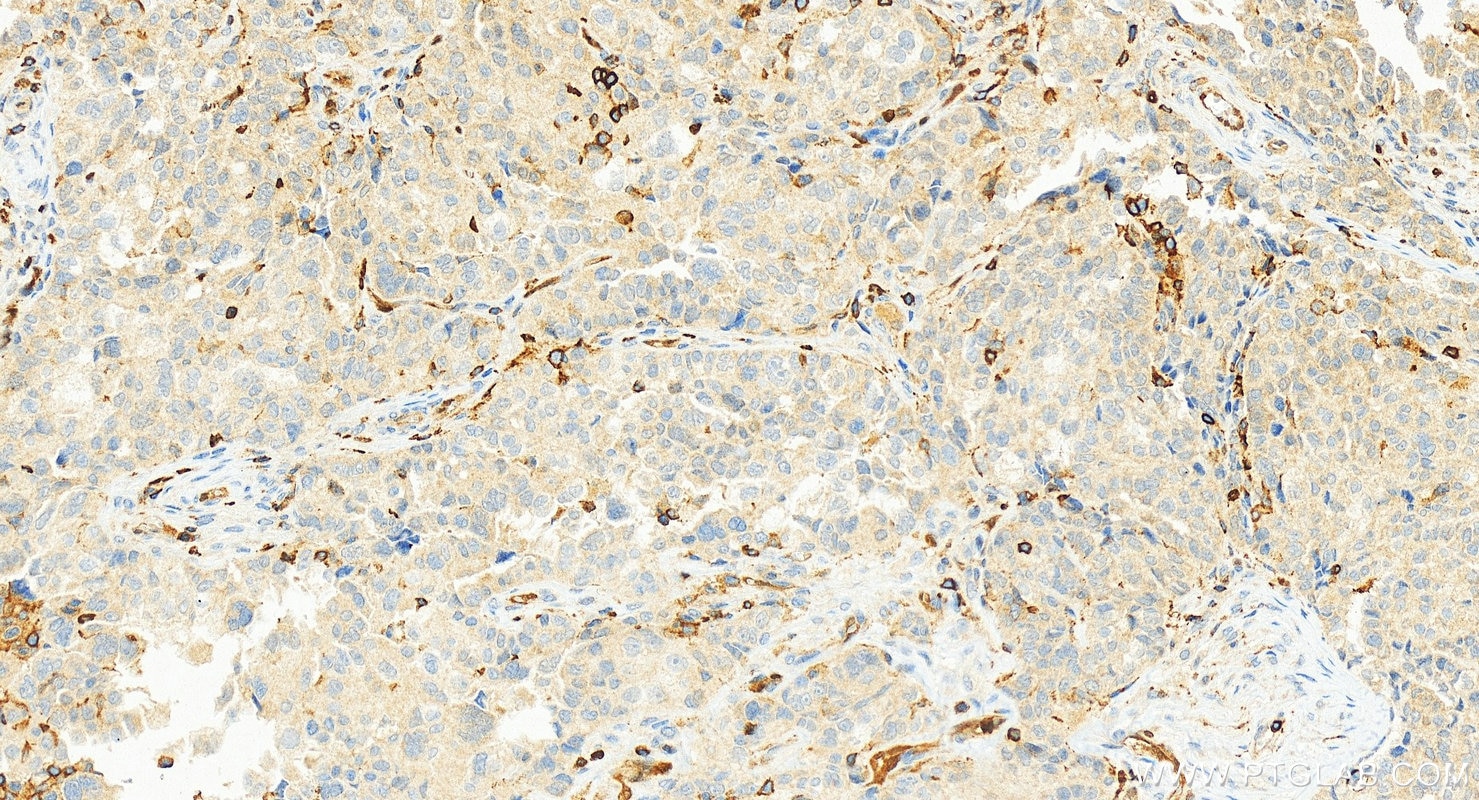 Immunohistochemistry (IHC) staining of human ovary cancer tissue using FKBP1A Polyclonal antibody (10273-1-AP)