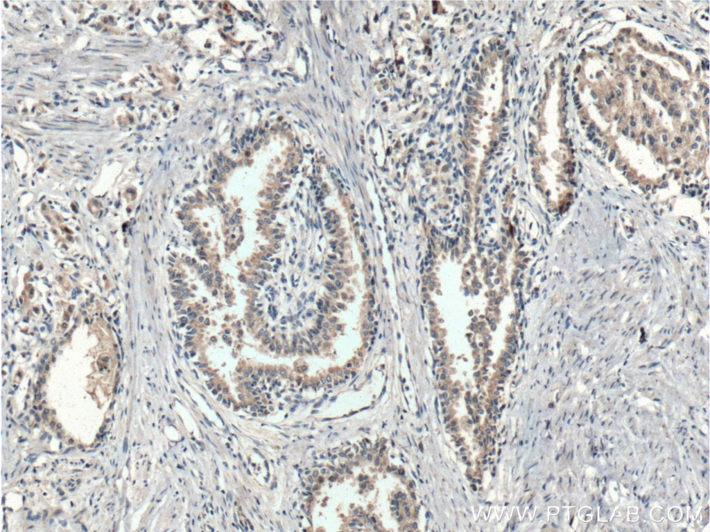 Immunohistochemistry (IHC) staining of human prostate cancer tissue using FKBP2 Polyclonal antibody (11700-1-AP)