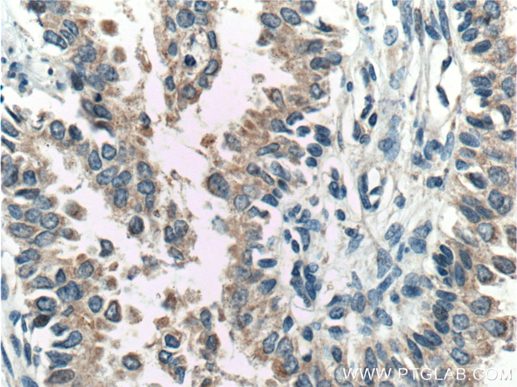 Immunohistochemistry (IHC) staining of human prostate cancer tissue using FKBP2 Polyclonal antibody (11700-1-AP)