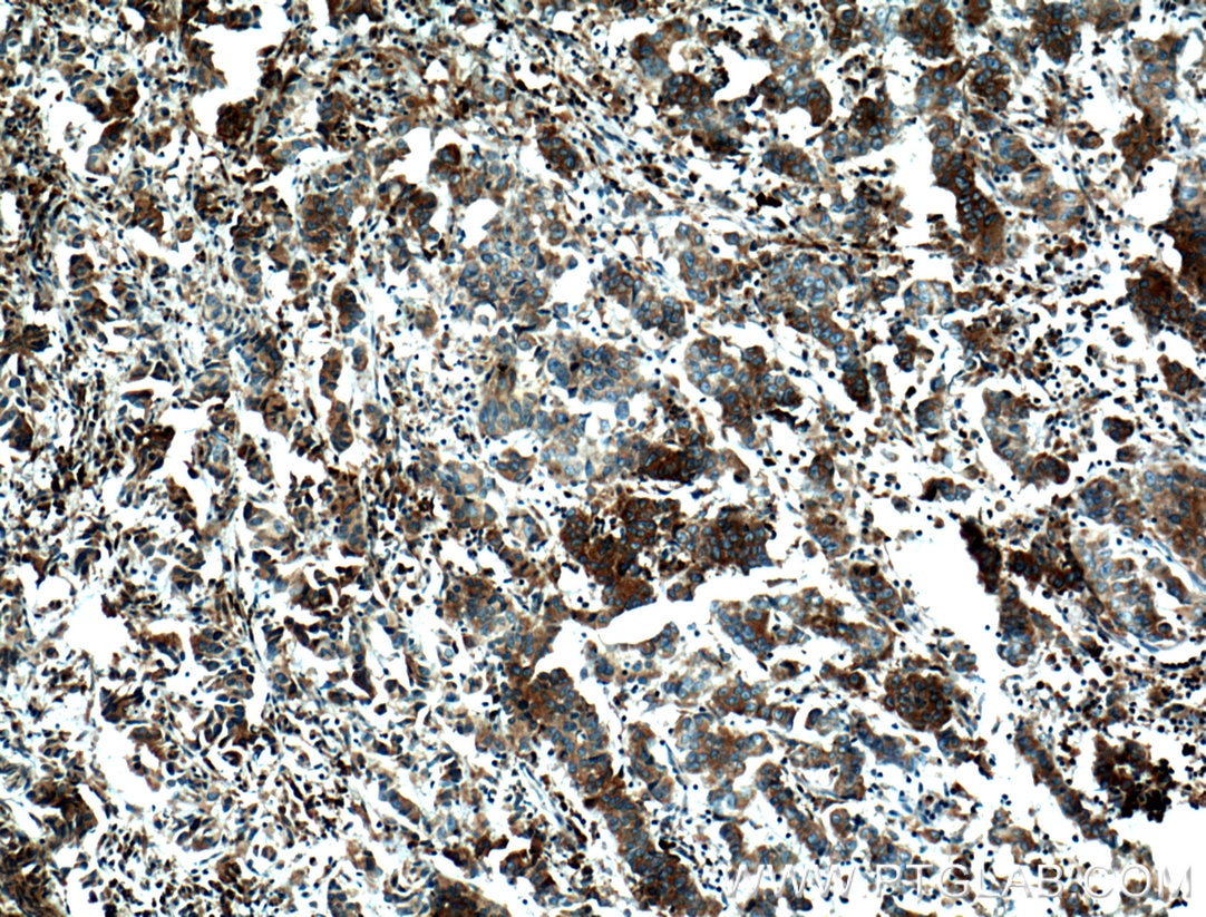 Immunohistochemistry (IHC) staining of human prostate cancer tissue using FKBP2 Monoclonal antibody (66091-1-Ig)