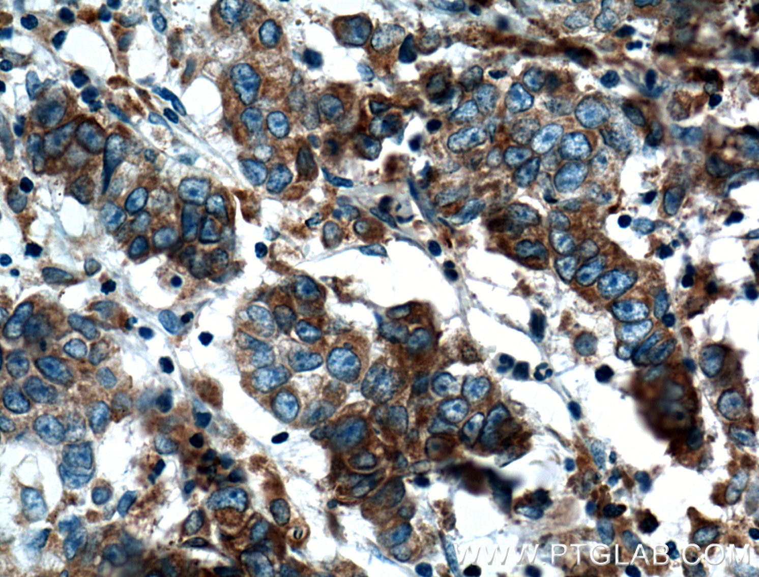 Immunohistochemistry (IHC) staining of human prostate cancer tissue using FKBP2 Monoclonal antibody (66091-1-Ig)