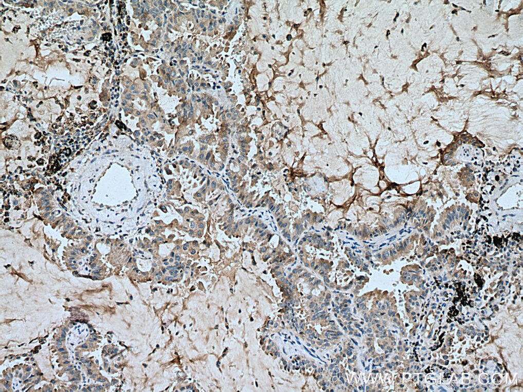 Immunohistochemistry (IHC) staining of human lung cancer tissue using FKBP3 Polyclonal antibody (11755-1-AP)