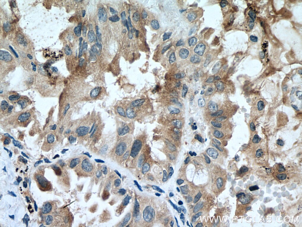 Immunohistochemistry (IHC) staining of human lung cancer tissue using FKBP3 Polyclonal antibody (11755-1-AP)