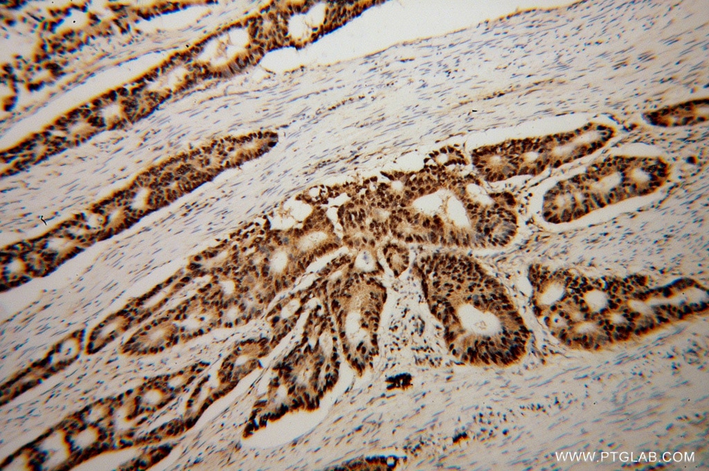 Immunohistochemistry (IHC) staining of human colon cancer tissue using FKBP5 Polyclonal antibody (14155-1-AP)