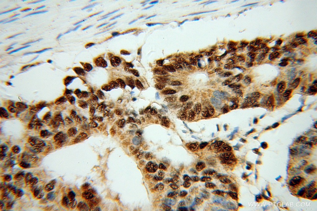 Immunohistochemistry (IHC) staining of human colon cancer tissue using FKBP5 Polyclonal antibody (14155-1-AP)