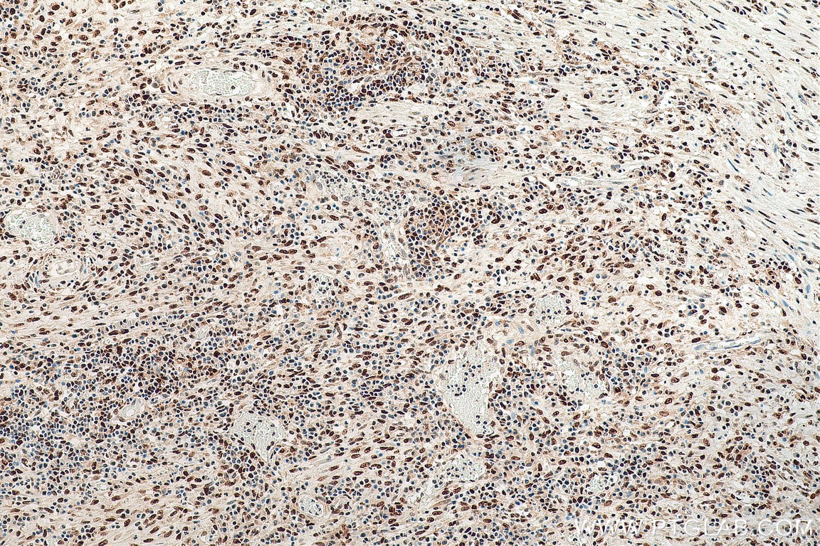 IHC staining of human colon cancer using 67874-1-Ig