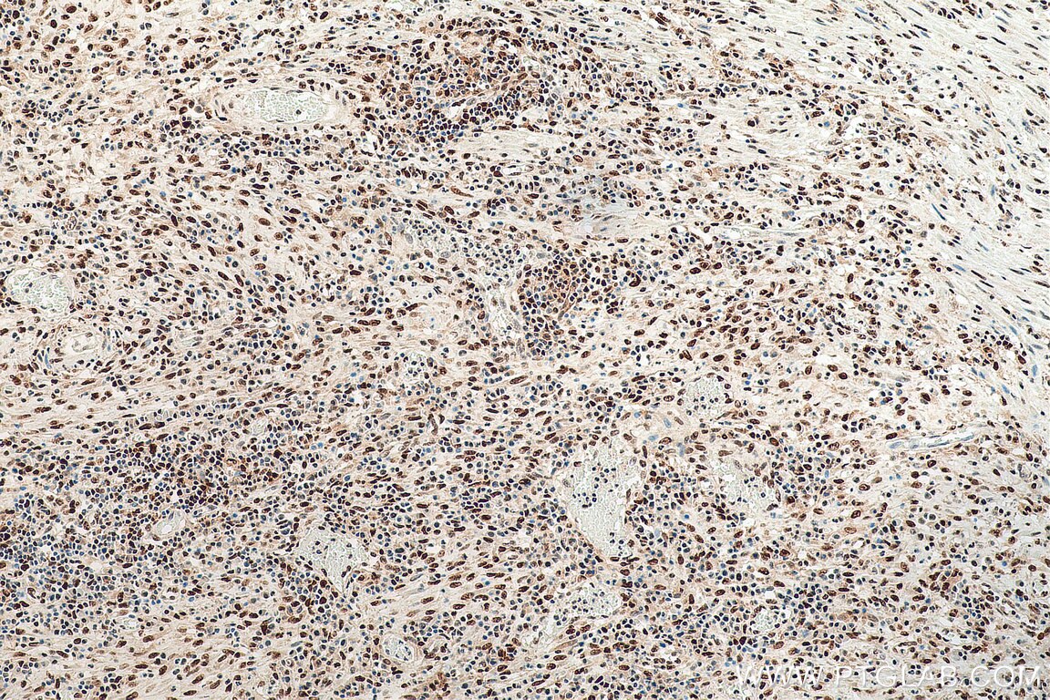 Immunohistochemistry (IHC) staining of human colon cancer tissue using FKBP5 Monoclonal antibody (67874-1-Ig)