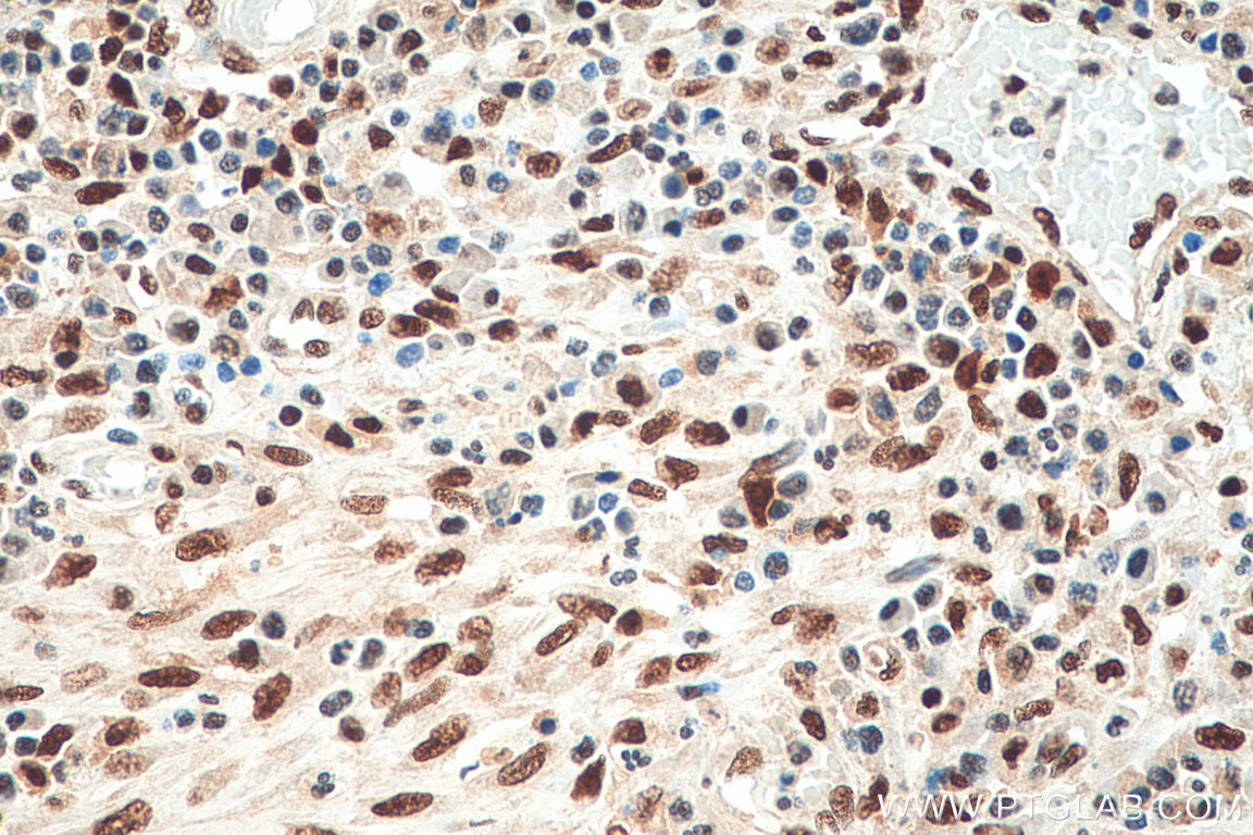 Immunohistochemistry (IHC) staining of human colon cancer tissue using FKBP5 Monoclonal antibody (67874-1-Ig)