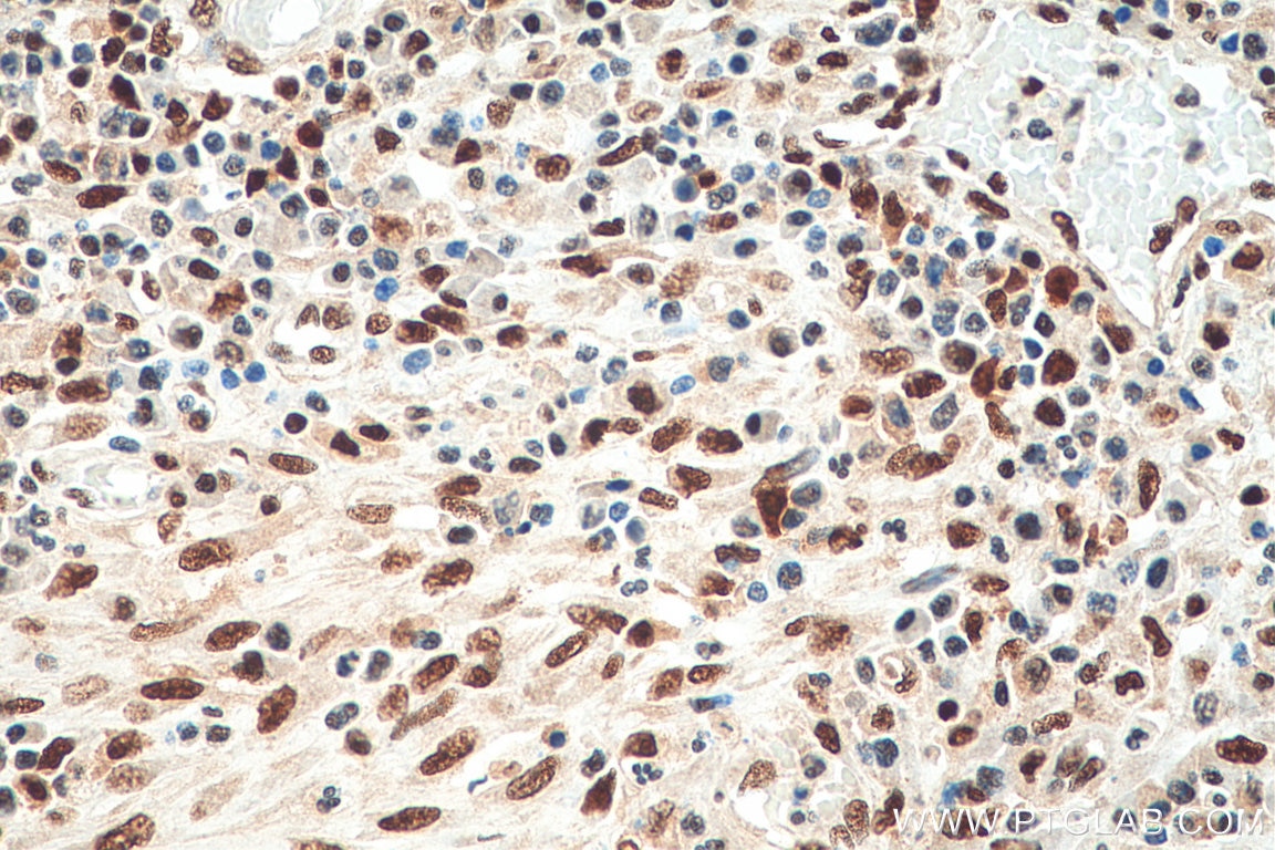 IHC staining of human colon cancer using 67874-1-Ig