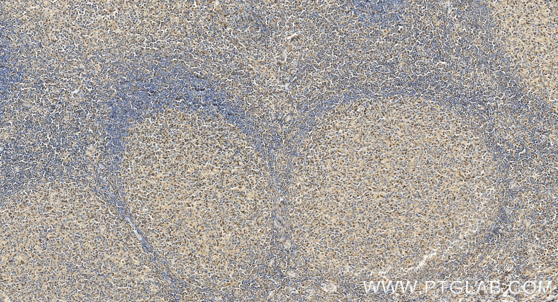 Immunohistochemistry (IHC) staining of human tonsillitis tissue using FKBP5 Recombinant monoclonal antibody (86189-2-RR)