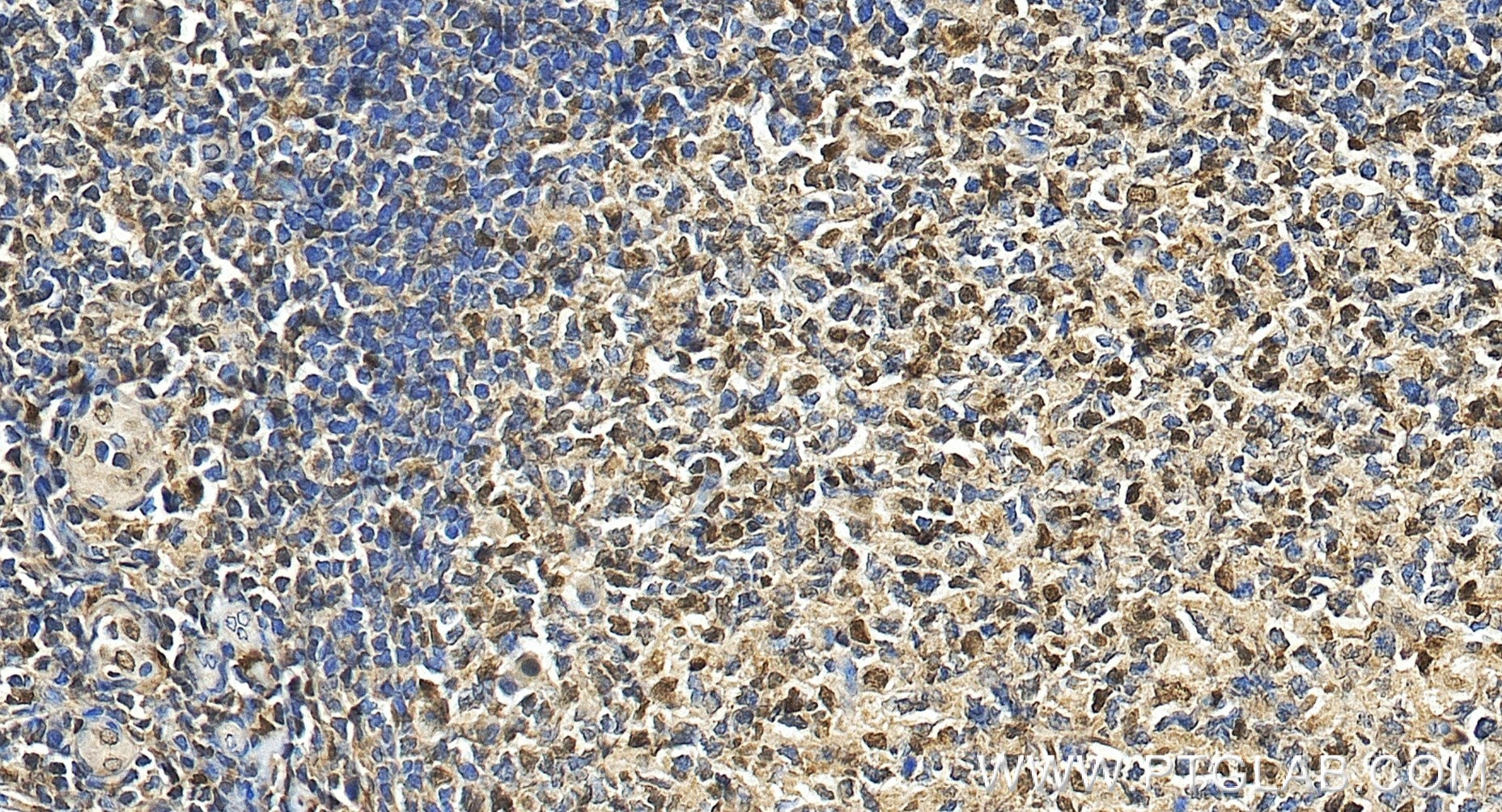Immunohistochemistry (IHC) staining of human tonsillitis tissue using FKBP5 Recombinant monoclonal antibody (86189-2-RR)