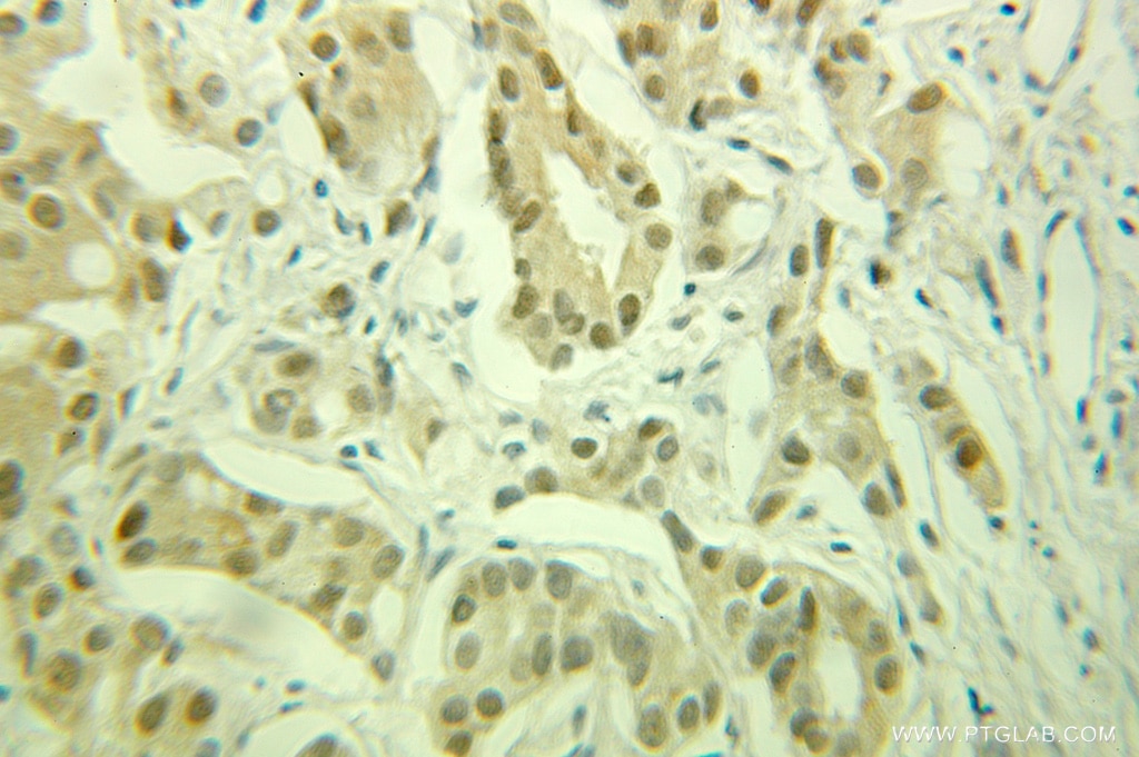 Immunohistochemistry (IHC) staining of human prostate cancer tissue using FKBP52 Polyclonal antibody (10655-1-AP)