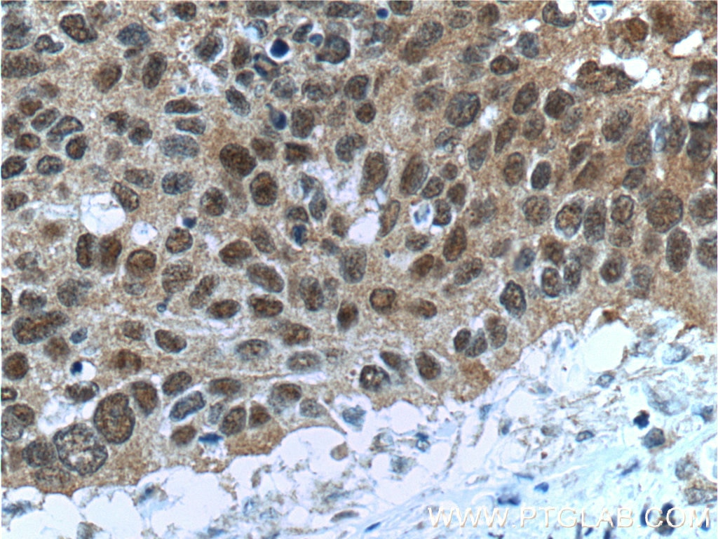 Immunohistochemistry (IHC) staining of human cervical cancer tissue using FKBP52 Monoclonal antibody (66040-1-Ig)