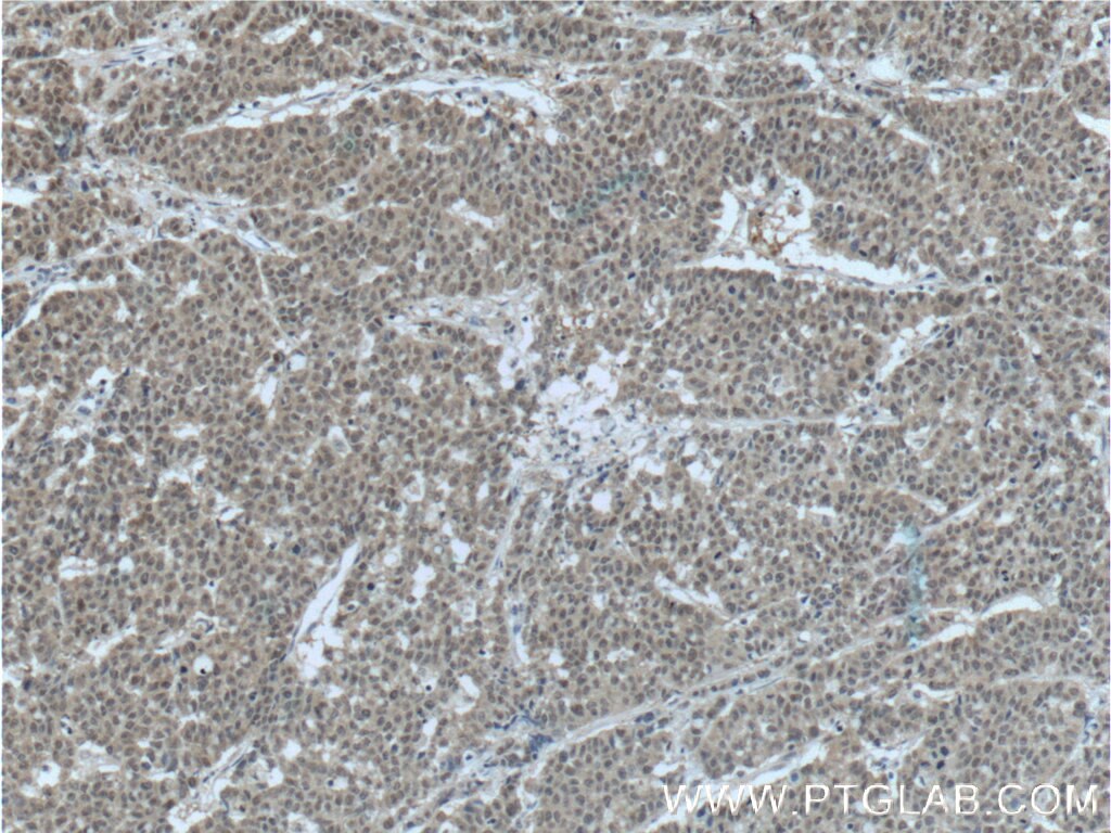 Immunohistochemistry (IHC) staining of human colon cancer tissue using FKBP52 Monoclonal antibody (66040-1-Ig)