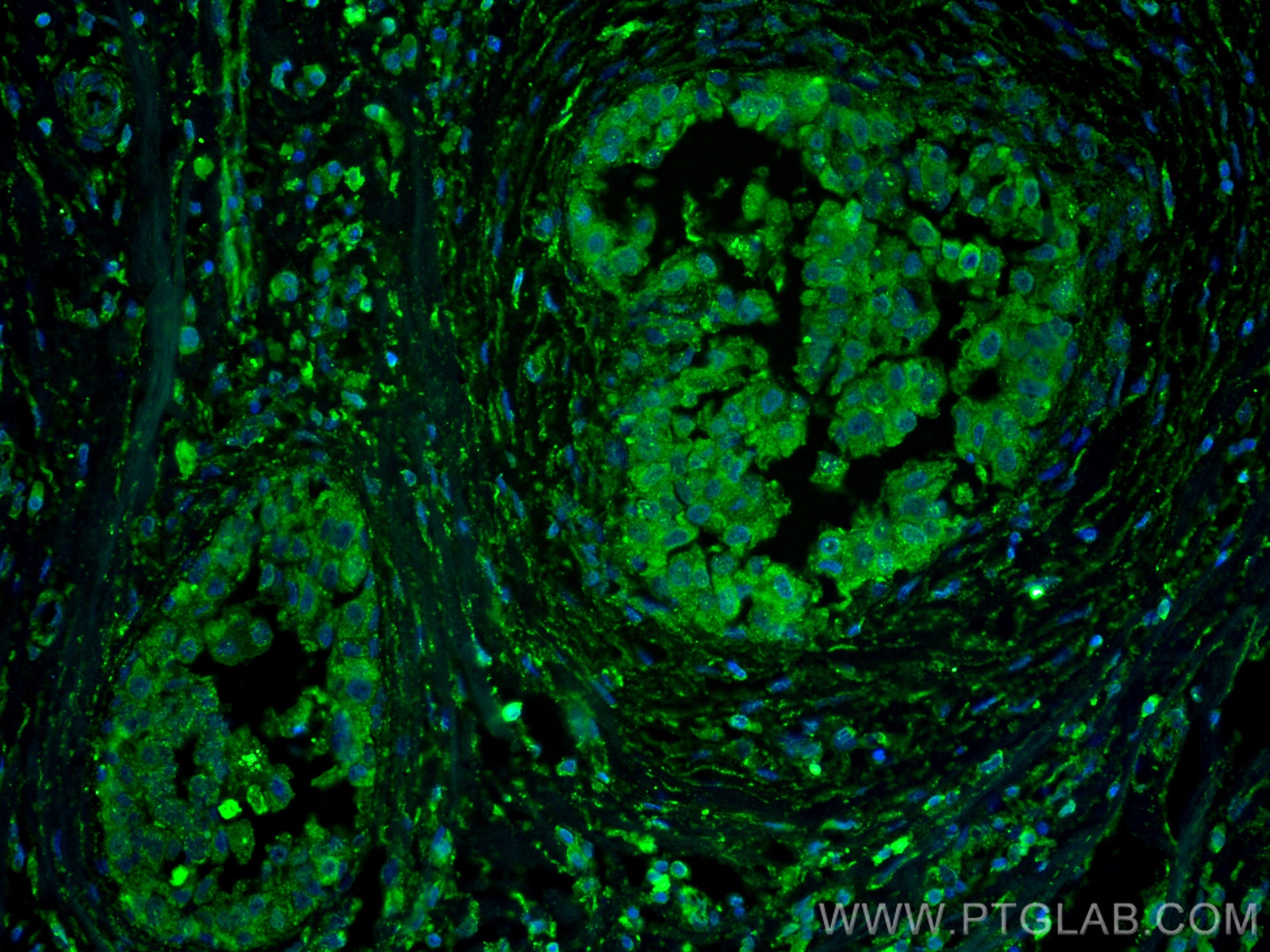 Immunofluorescence (IF) / fluorescent staining of human breast cancer tissue using FKBP52 Monoclonal antibody (66040-2-Ig)