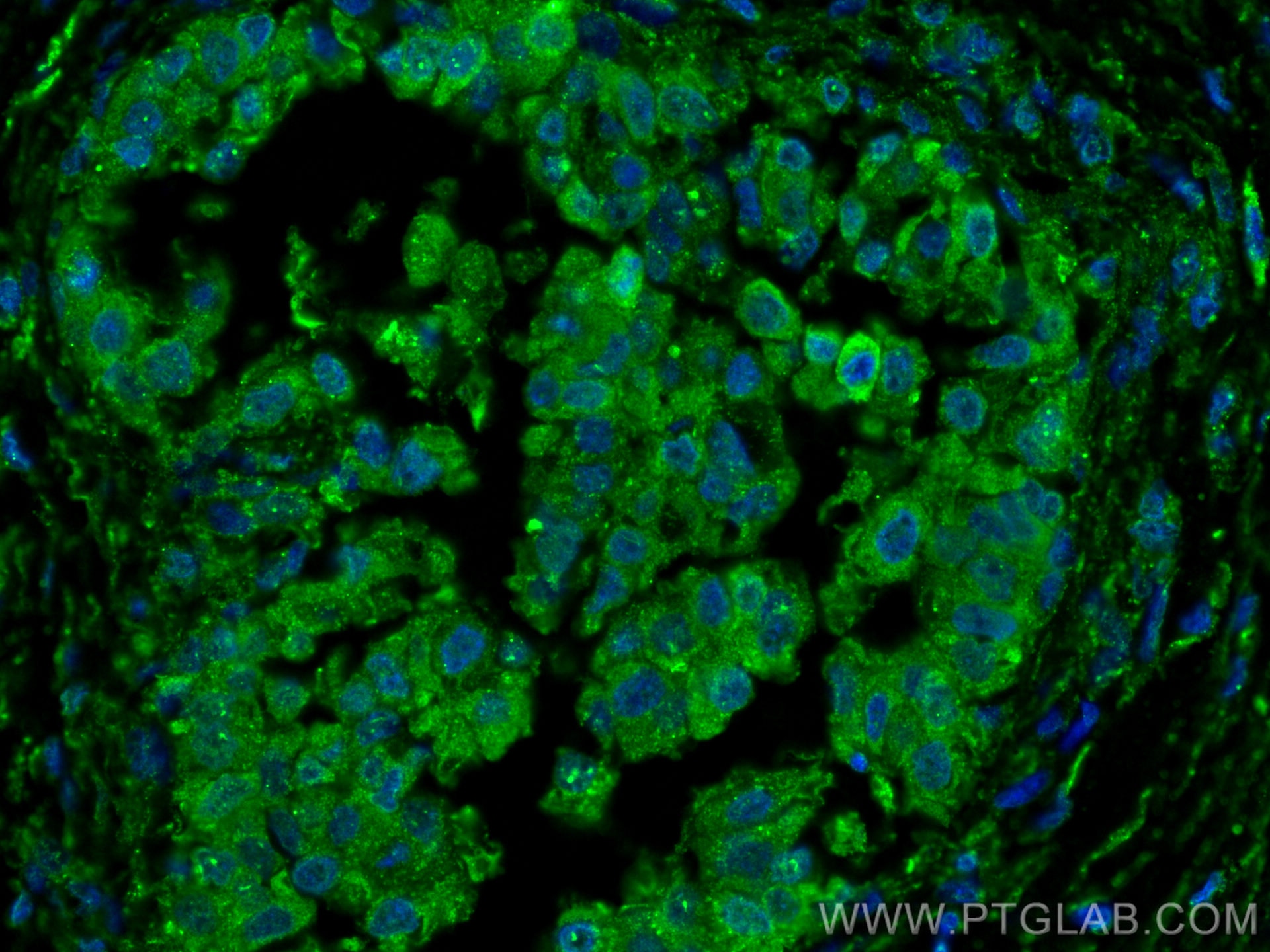 Immunofluorescence (IF) / fluorescent staining of human breast cancer tissue using FKBP52 Monoclonal antibody (66040-2-Ig)