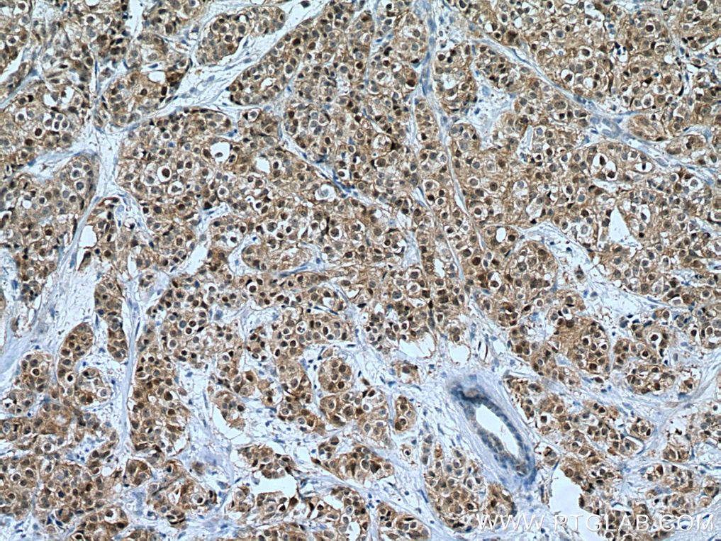 Immunohistochemistry (IHC) staining of human breast cancer tissue using FKBP52 Monoclonal antibody (66040-2-Ig)