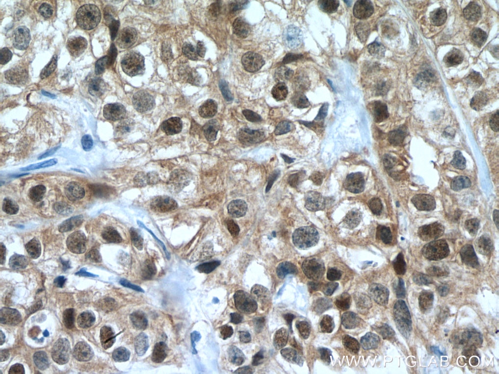 Immunohistochemistry (IHC) staining of human breast cancer tissue using FKBP52 Monoclonal antibody (66040-2-Ig)