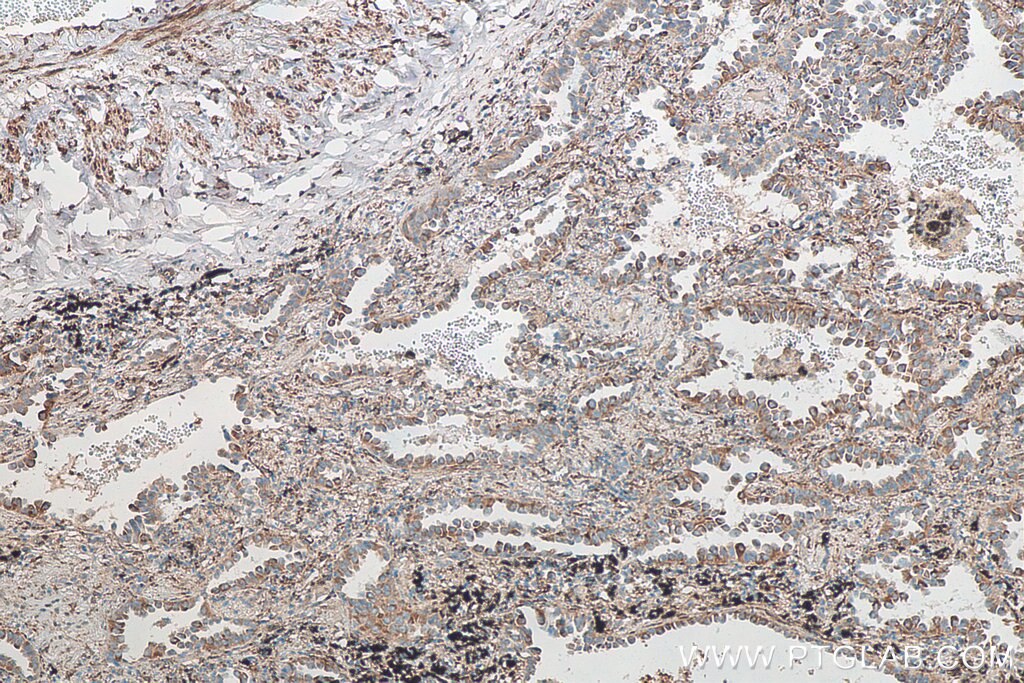 Immunohistochemistry (IHC) staining of human lung cancer tissue using FKBP7 Polyclonal antibody (12092-1-AP)