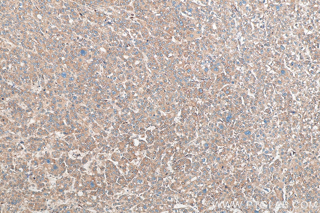 Immunohistochemistry (IHC) staining of human liver cancer tissue using FKBP7 Polyclonal antibody (12092-1-AP)