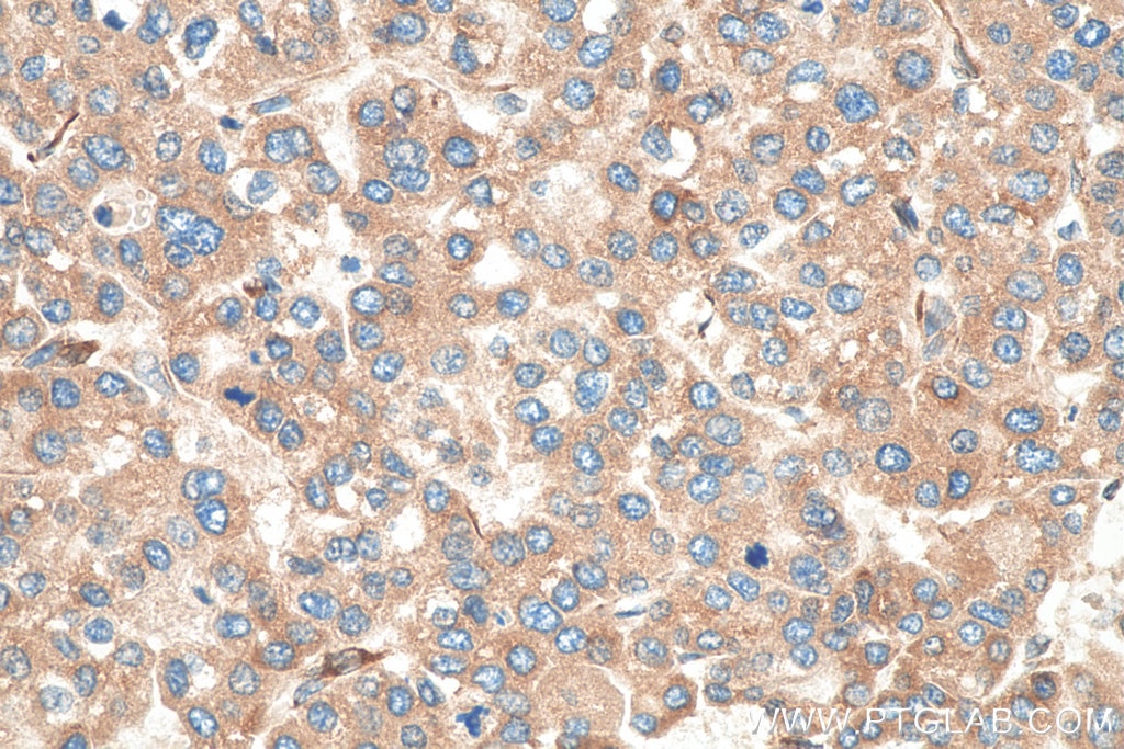 Immunohistochemistry (IHC) staining of human liver cancer tissue using FKBP7 Polyclonal antibody (12092-1-AP)