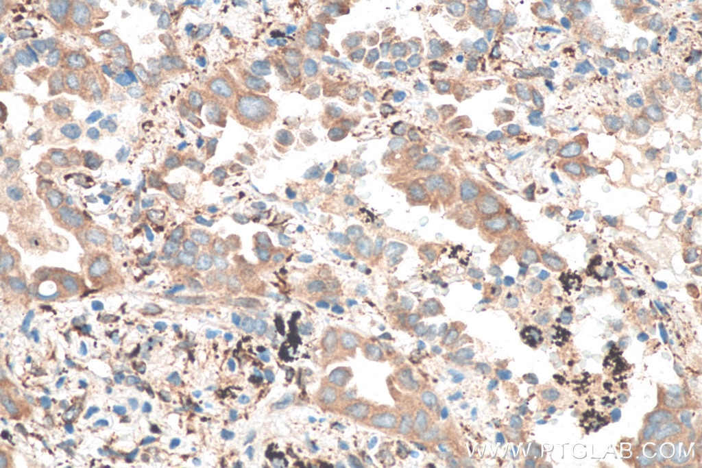 Immunohistochemistry (IHC) staining of human lung cancer tissue using FKBP7 Polyclonal antibody (12092-1-AP)
