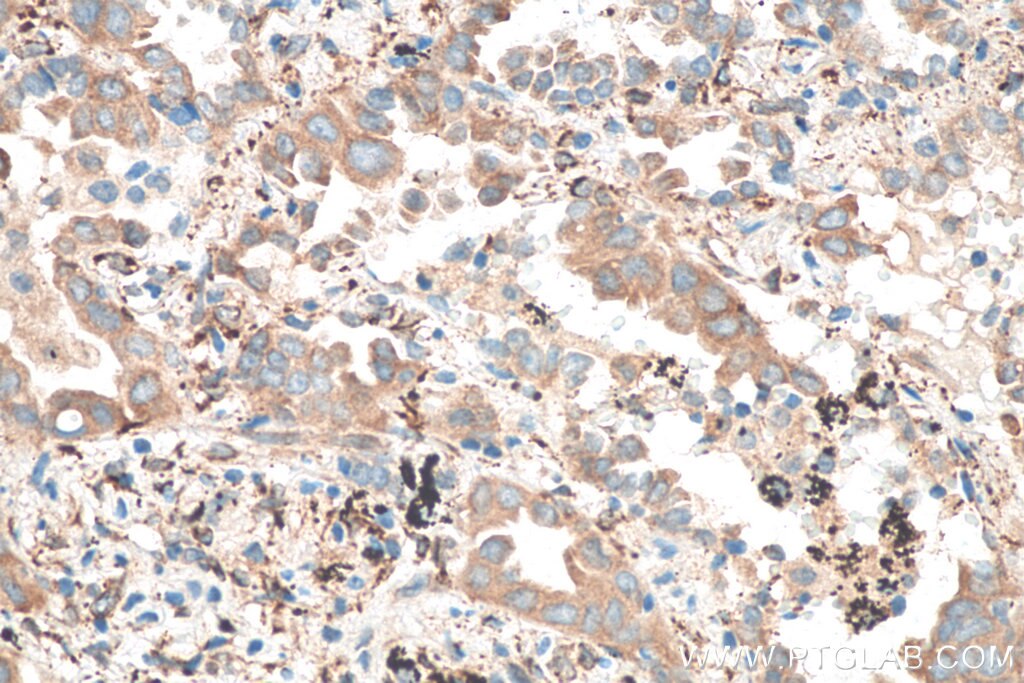 IHC staining of human lung cancer using 12092-1-AP