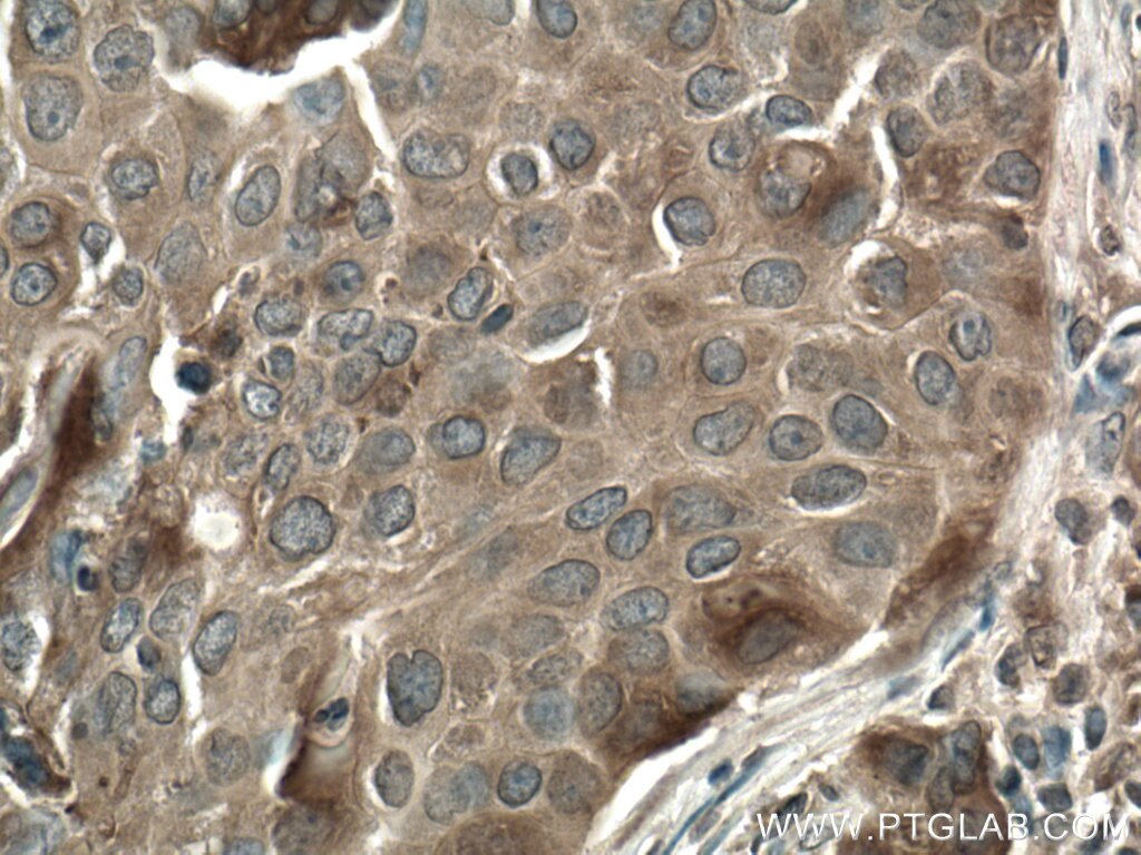IHC staining of human breast cancer using 10060-1-AP