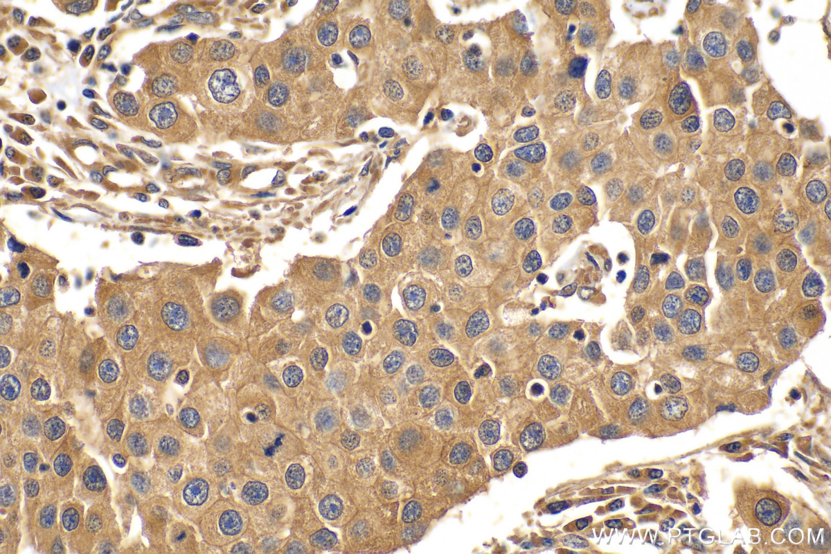 Immunohistochemistry (IHC) staining of human breast cancer tissue using FKBPL Polyclonal antibody (10060-1-AP)