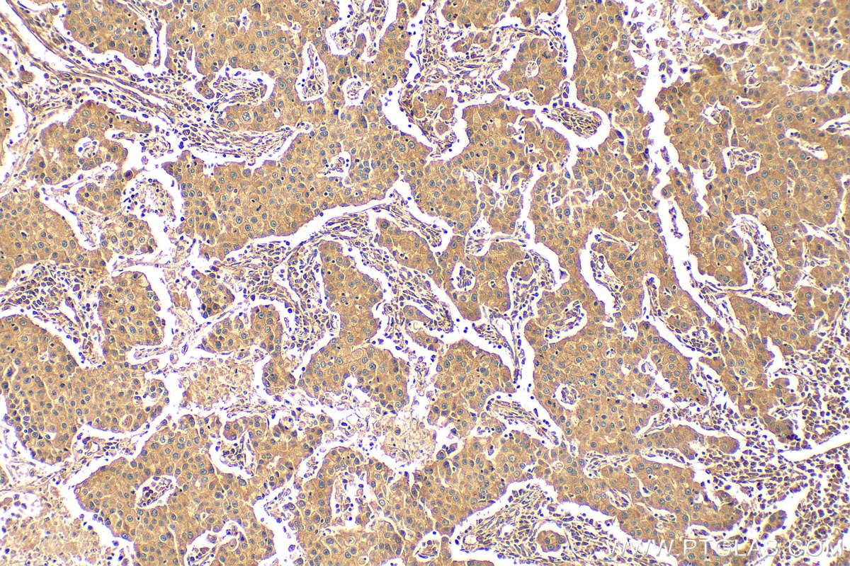 Immunohistochemistry (IHC) staining of human breast cancer tissue using FKBPL Polyclonal antibody (10060-1-AP)