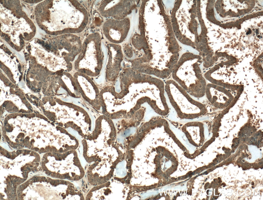 Immunohistochemistry (IHC) staining of human ovary tumor tissue using FKBPL Polyclonal antibody (23369-1-AP)