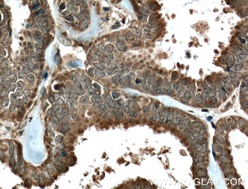 IHC staining of human ovary tumor using 23369-1-AP