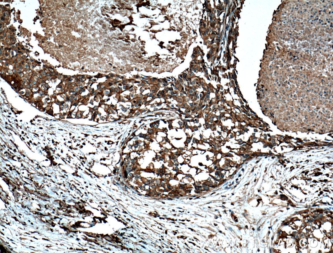 Immunohistochemistry (IHC) staining of human breast cancer tissue using FKBPL Monoclonal antibody (66389-1-Ig)